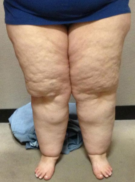 lipoedema-legs_3.jpg